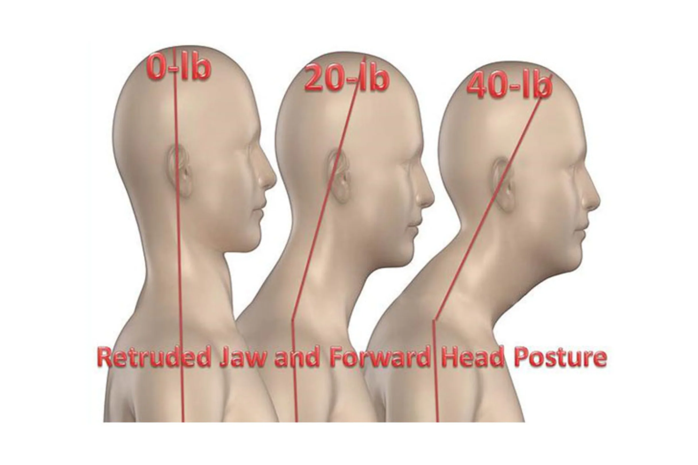 Effective Techniques to Correct Forward Head Posture